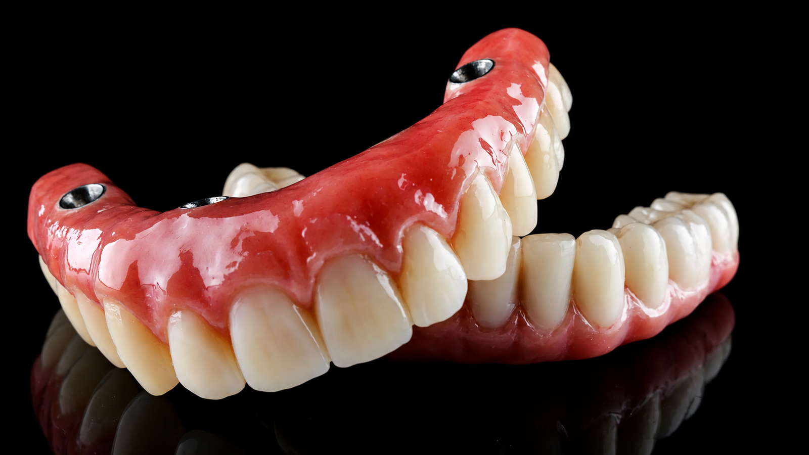 Screw-retained overdenture with titanium bar